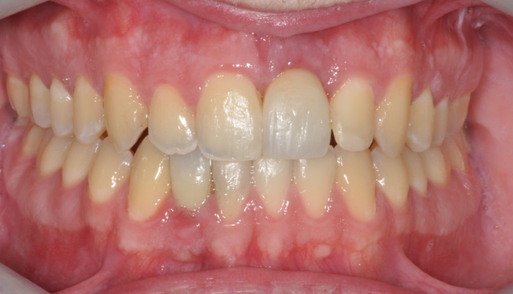 Implant #9 with Crown