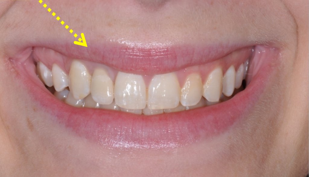 Implant #7 with Crown