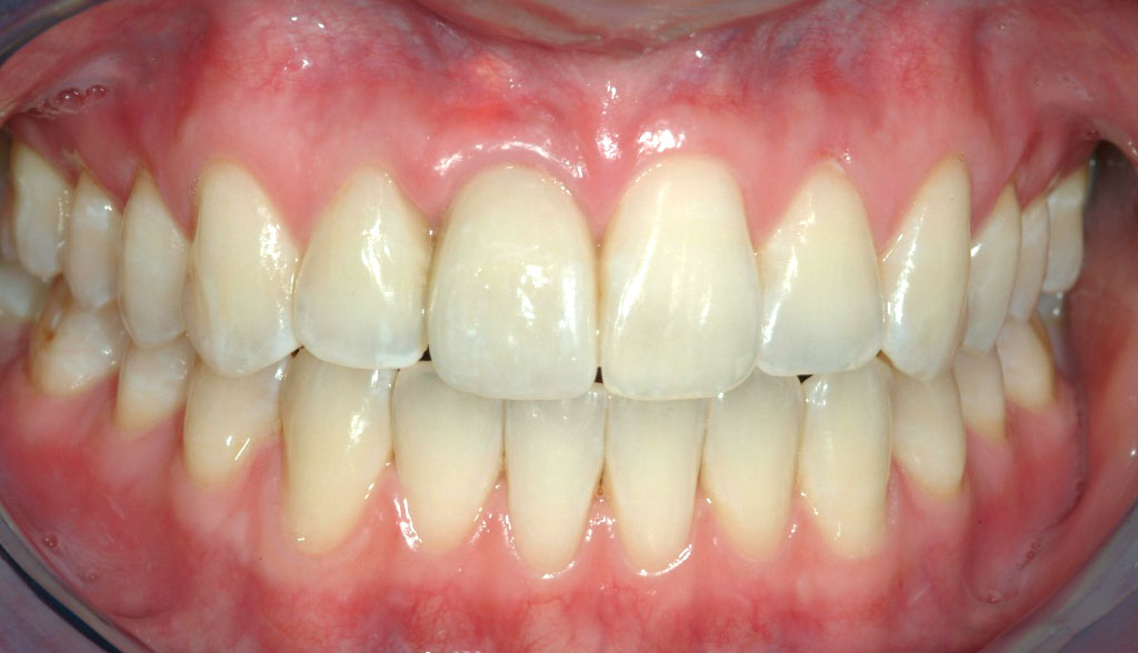 Implant #8 with Crown